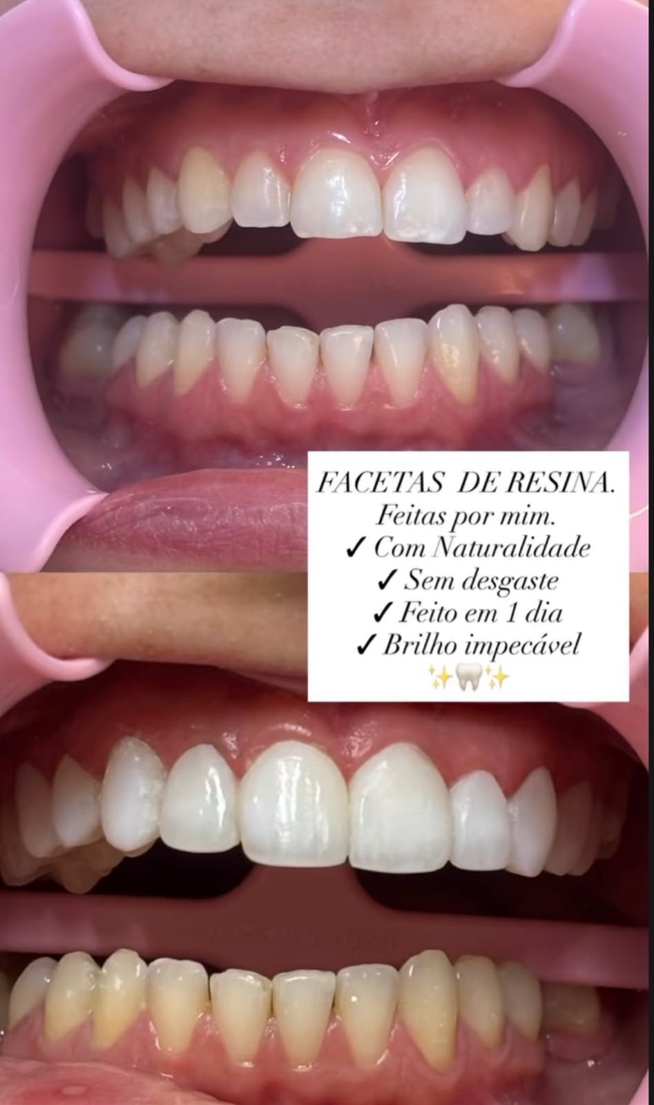 Resultado de facetas em resina realizadas pela Dra. Cristina Braz